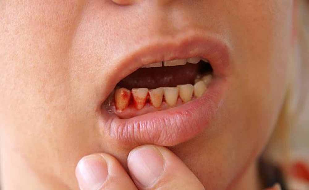 मसूड़ों से खून आने की समस्या को करें दूर, अपनाएं ये कारगर टिप्स