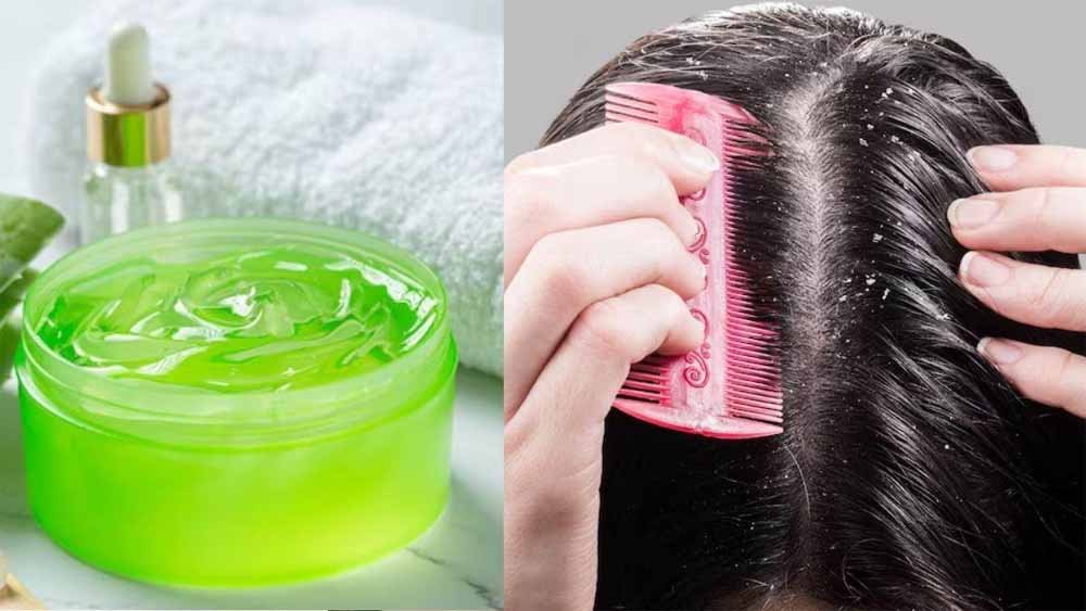 आंवला और एलोवेरा से पाएं डैंड्रफ और हेयर फॉल से छुटकारा – जानें 4 आसान तरीके