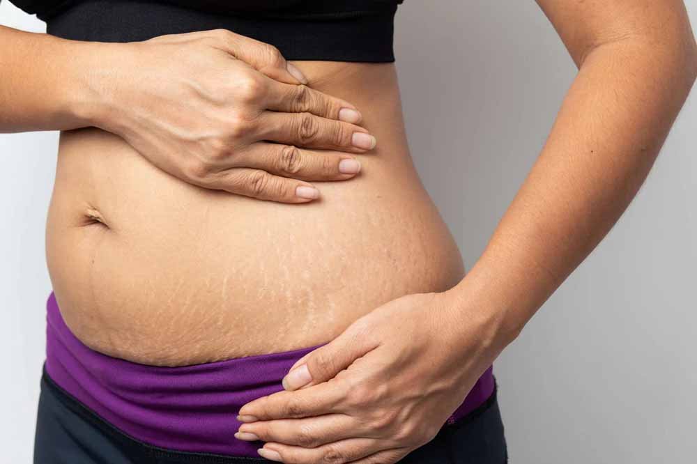 स्ट्रेच मार्क्स पर नारियल तेल का असर: मिथ या सच? जानिए विशेषज्ञ की राय
