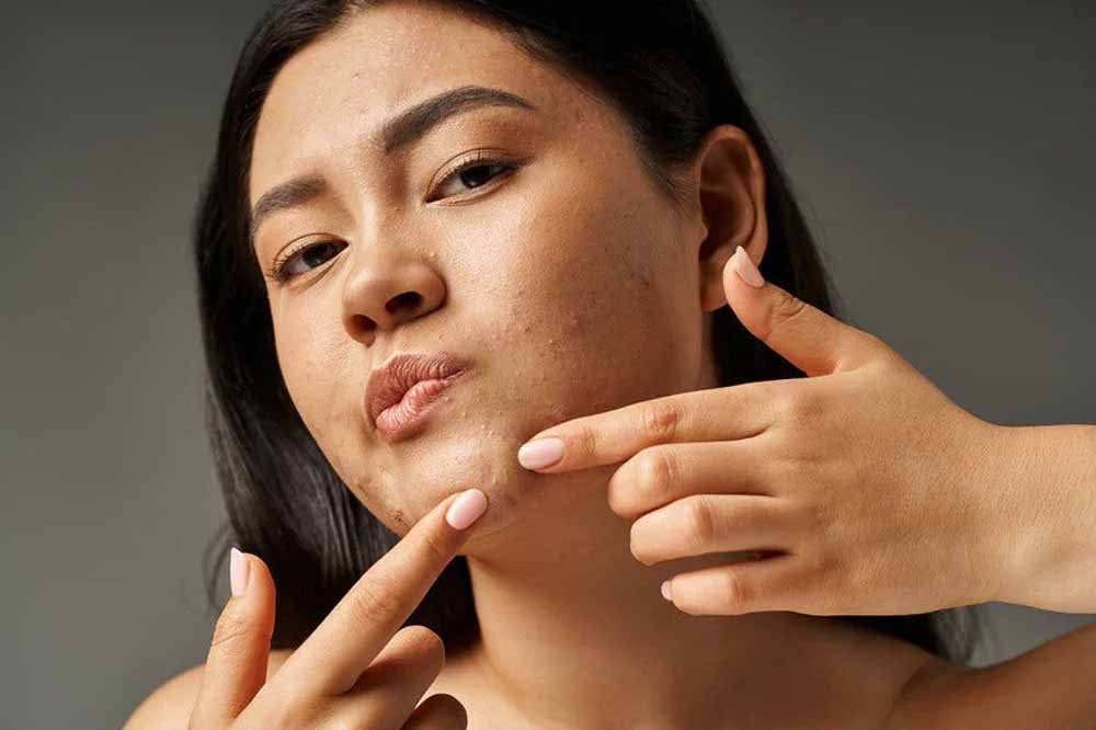 ऐसे करें सैलिसिलिक एसिड का इस्तेमाल, चेहरे से पिंपल्स होंगे गायब