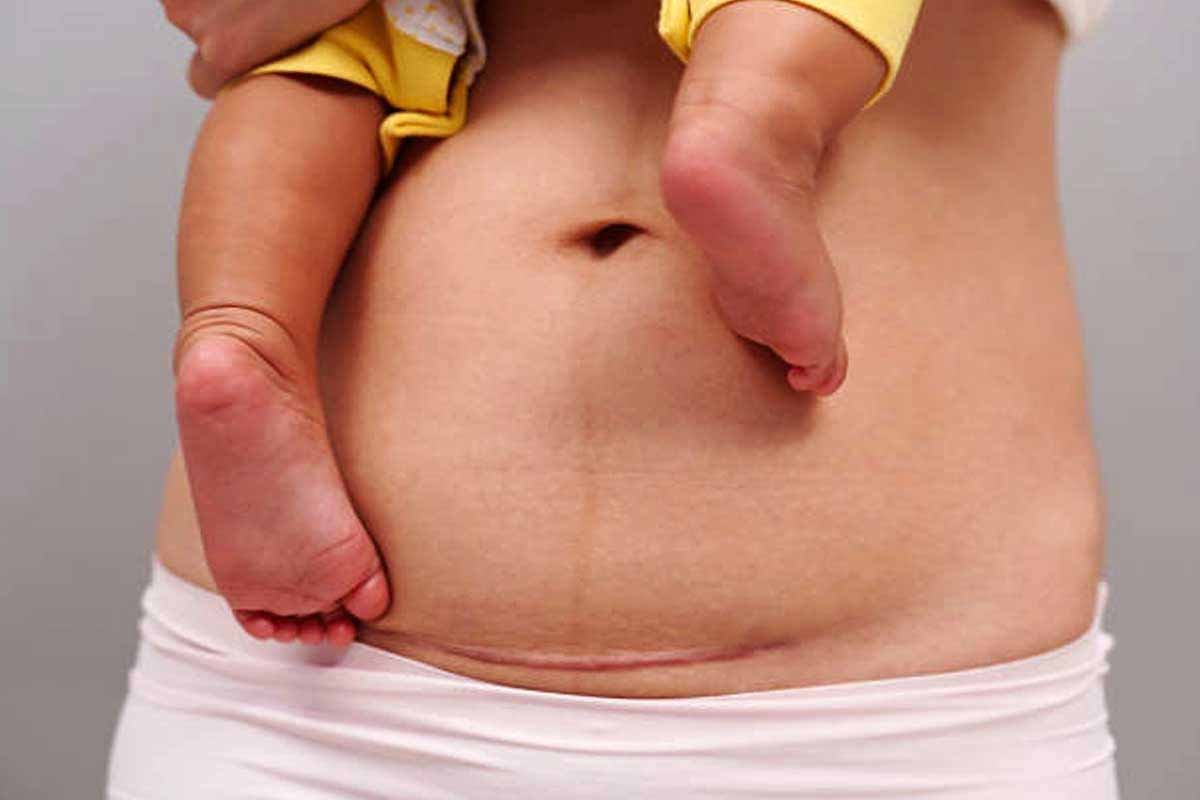 सिजेरियन डिलीवरी का बढ़ता चलन,मेडिकल जरूरत या बड़ा बिज़नेस?