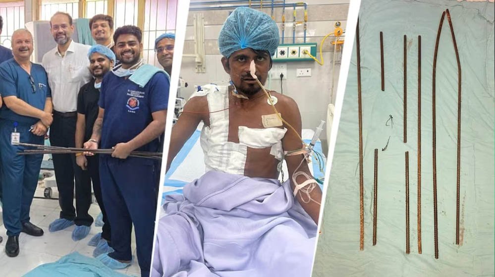 दर्दनाक हादसे के बाद मेडिकल चमत्कार, शरीर में धंसे 4 सरियों को KGMU के डॉक्टरों ने सफल ऑपरेशन स