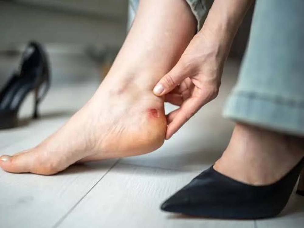 नए जूतों के छालों से राहत देंगे ये घरेलू नुस्खे, दर्द होगा दूर