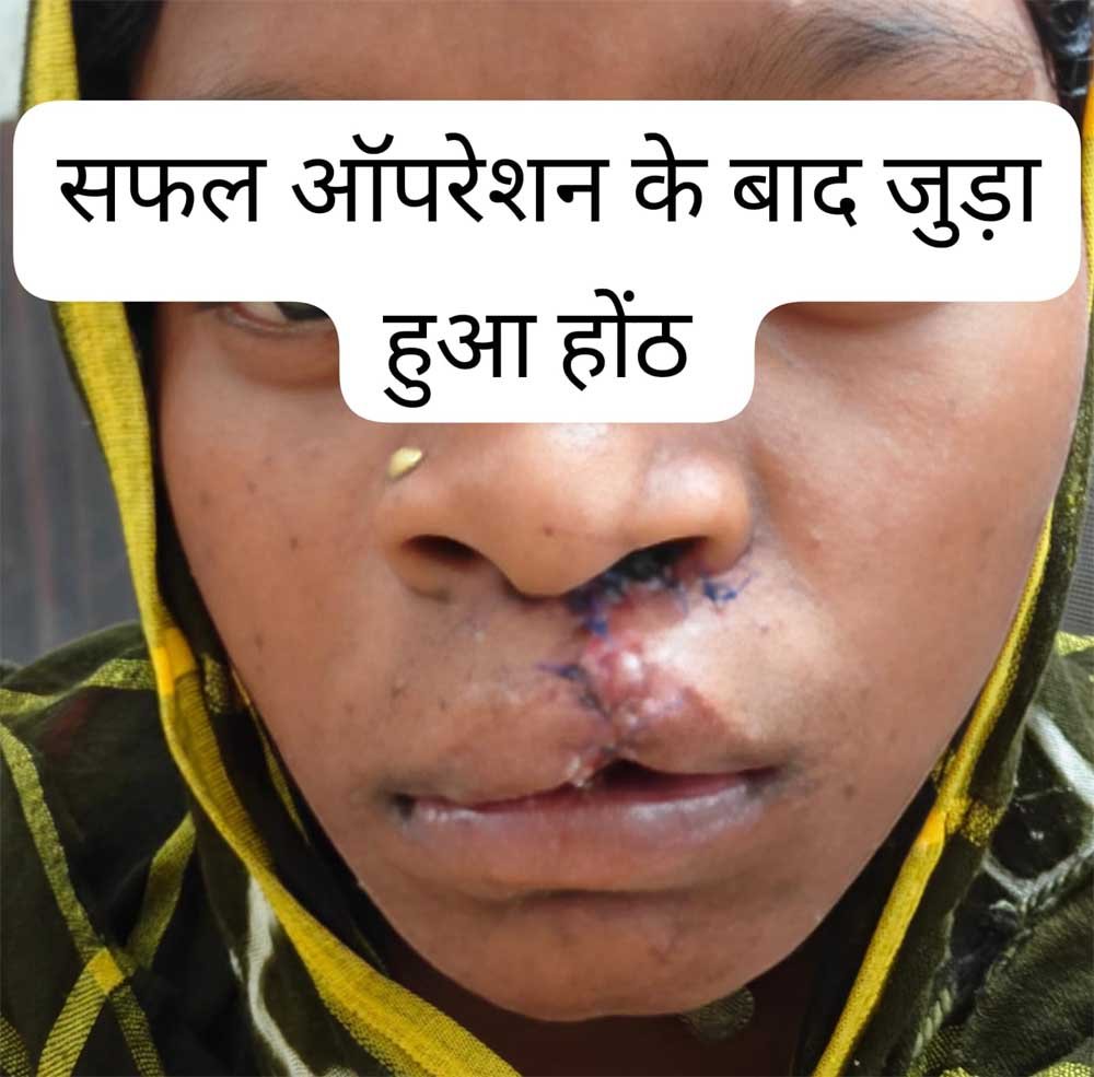 जन्मजात होंठ की विकृति का हुआ सफल उपचार, अब सामान्य जीवन जी रही हैं 22 वर्षीय युवती