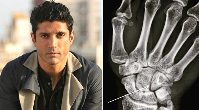 Farhan Akhtar injured during 'Toofan' shoot