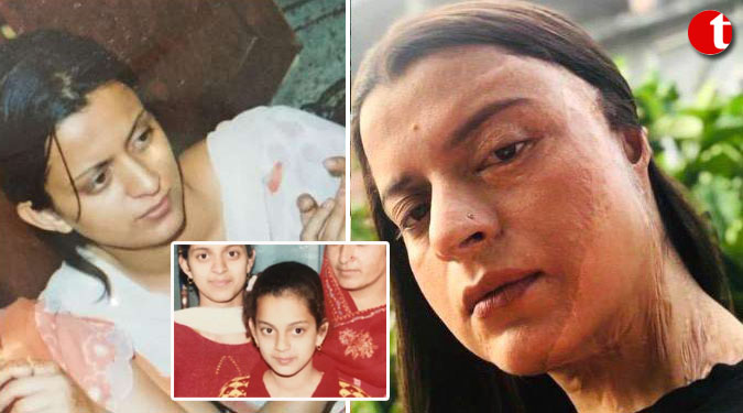 Kangana”s sister Rangoli reveals horrific details of acid attack