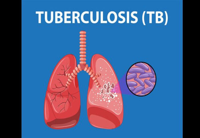 मध्य प्रदेश के 19 जिलों में तेजी से बढ़े TB मरीज, केंद्र सरकार के आंकड़ों ने डराया