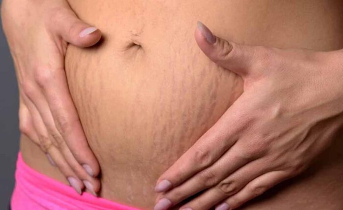 अब स्ट्रेच मार्क्स नहीं! घर पर ही अपनाएं ये घरेलू नुस्खे