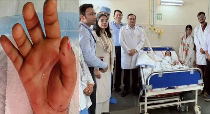 एम्स पटना के डॉक्टरों ने सर्जरी कर बच्ची का कटा हाथ जोड़ा