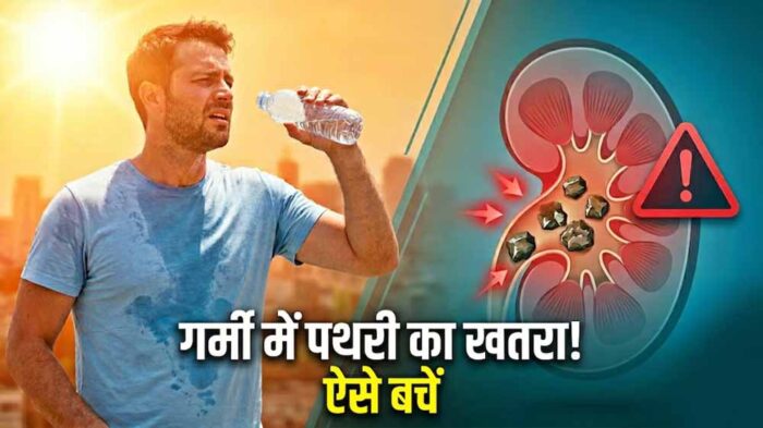 गर्मी में बढ़ा किडनी स्टोन का खतरा, डिहाइड्रेशन बन रहा बड़ा कारण