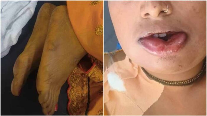हल्दी रस्म के दौरान हुआ हादसा, चेहरे पर सूजन के बाद दुल्हन ने तोड़ा दम