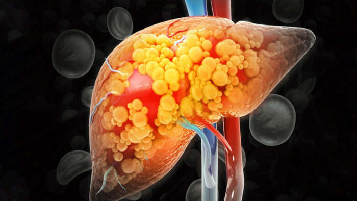 Fatty Liver Alert: AIIMS डॉक्टर बोले- तुरंत छोड़ दें ये 4 चीजें, शराब जितना पहुंचाती हैं लिवर को नुकसान