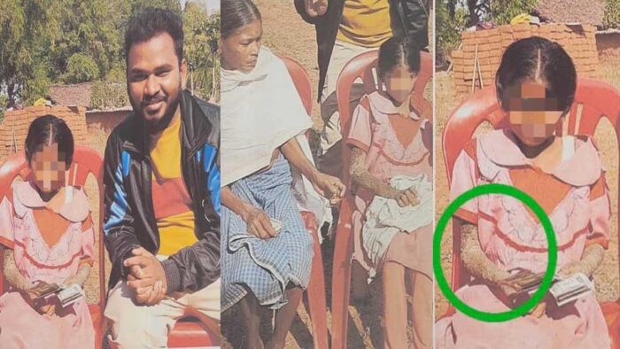 पत्थर जैसी बन रही बच्ची का होगा इलाज, बाल आयोग ने मामले में दिखाई सक्रियता