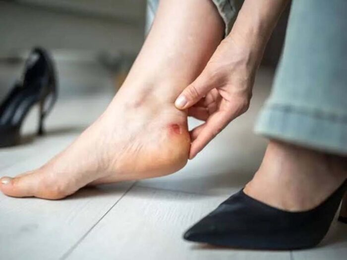 नए जूतों के छालों से राहत देंगे ये घरेलू नुस्खे, दर्द होगा दूर